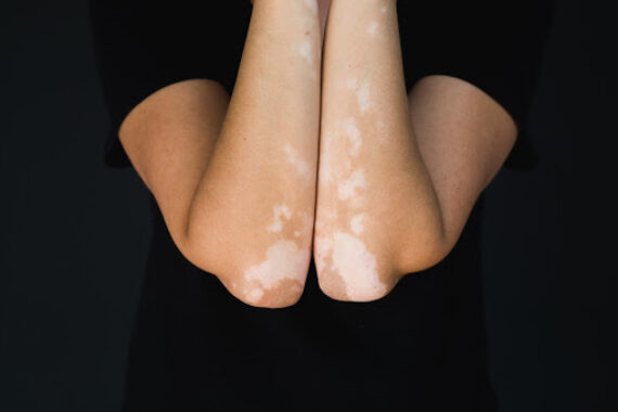 Is It Safe to Treat Vitiligo in the Winter?